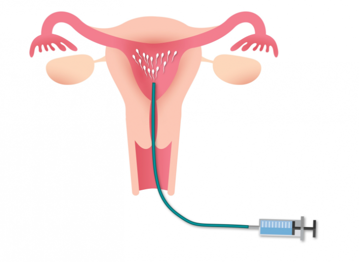 IUI IUI